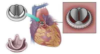 Операція по заміні (протезування) клапана серця
