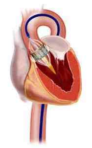 Операція по заміні (протезування) клапана серця
