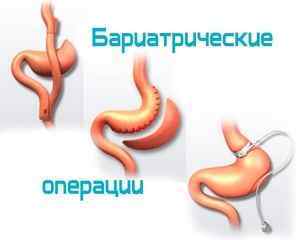 Операція по зменшенню шлунка: популярні методики, ціна в Москві, відгуки