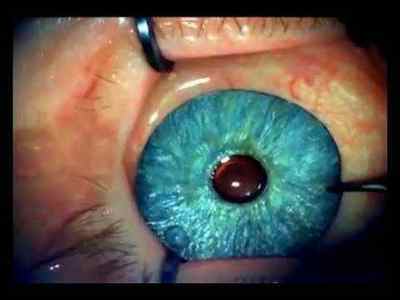 Операція по зміні кольору очей: лазерне зміна, інші види корекції