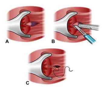 Операція при анальної тріщині: висічення, видалення, сфинктеротомия