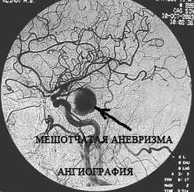 Операція при аневризмі судин головного мозку: видалення, наслідки