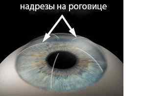 Операція при астигматизмі на очі: види, вартість