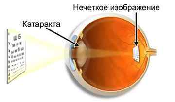 Операція при катаракті ока: суть, ціни, реабілітація