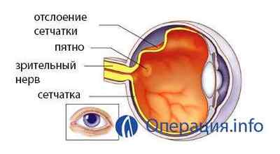 Операція при катаракті ока: суть, ціни, реабілітація