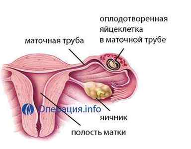 Операція при позаматкової вагітності: з видаленням труби (тубектомія) і без