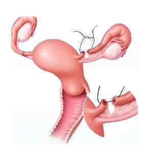 Операція при позаматкової вагітності: з видаленням труби (тубектомія) і без
