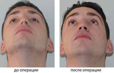 Операція при викривленні носової перегородки (септопластика)