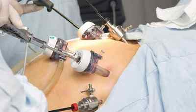 Операція при виразці шлунка: проривної, планове видалення