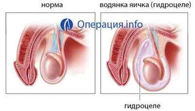 Операція при водянці яєчка /гидроцеле у дітей, чоловіків