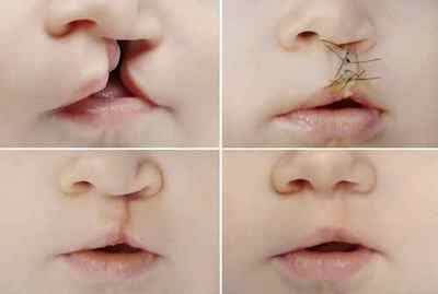 Операція при заячою губі і вовчої пащі: хід, ефективність, реабілітація