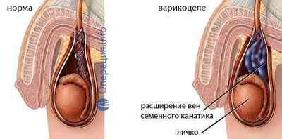 Операція Іваніссевіча (при варикоцеле): суть методу, хід, відновлення після