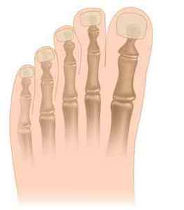 Операція з видалення кісточок на ногах, шишок пальців