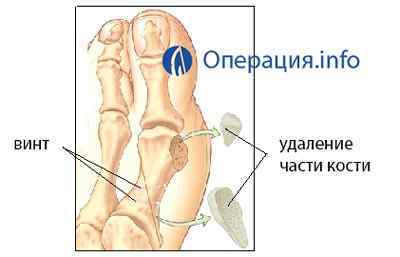 Операція з видалення кісточок на ногах, шишок пальців