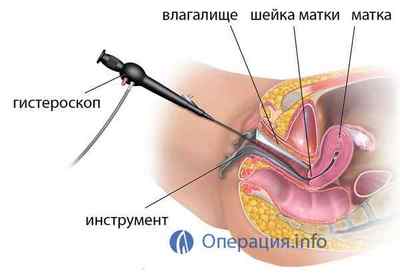 Операція з видалення матки, гістеректомія, екстирпація
