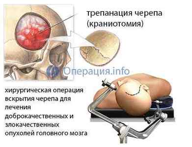 Операція з видалення пухлини головного мозку