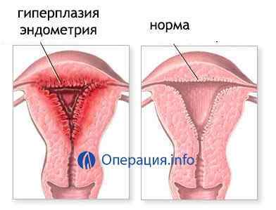 Операція з видалення раку матки (шийки і тіла): Вертгейма і інші