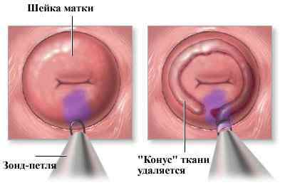 Операція з видалення раку матки (шийки і тіла): Вертгейма і інші