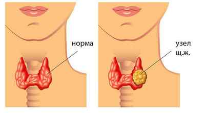 Операція з видалення вузлів щитовидної залози: показання, хід, реабілітація