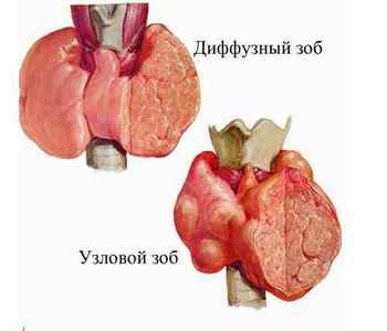 Операція з видалення вузлів щитовидної залози: показання, хід, реабілітація