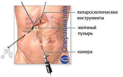 Операція з видалення жовчного міхура: холецистектомія