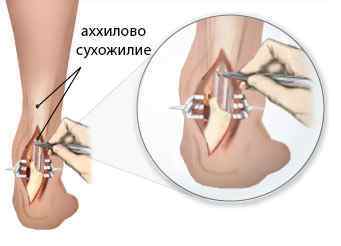 Операції на ахіллове сухожилля (Ахілла) при розриві і травмах; лікування після