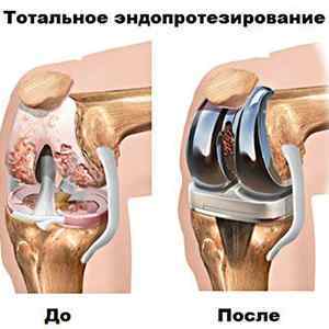 Операції на колінному суглобі: реабілітація після операції, вправи для відновлення і розробки, скільки коштує операція | Ревматолог