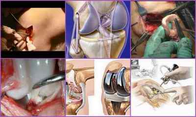 Операції на колінному суглобі: види і реабілітація