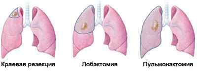 Операції на легенях при раку і інших захворюваннях
