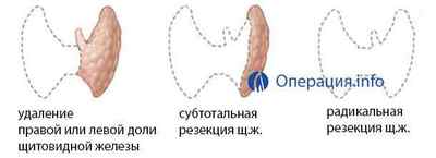 Операції на щитовидній залозі, резекція, струмектомія
