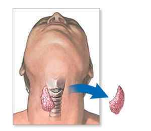 Операції на щитовидній залозі, резекція, струмектомія