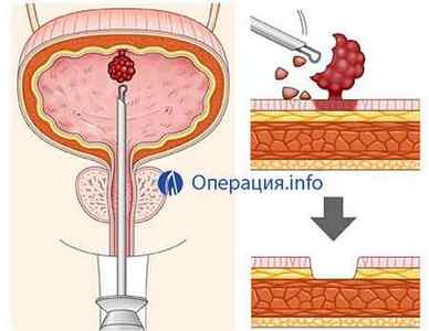 Операції на сечовому міхурі: цистектомія, видалення, резекція