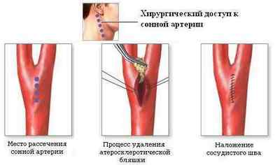 Операції на сонній артерії: при стенозі, бляшці, атеросклерозі