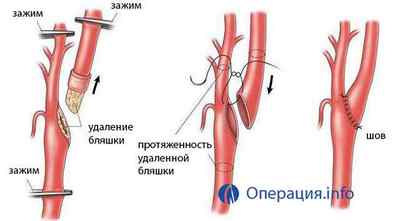 Операції на сонній артерії: при стенозі, бляшці, атеросклерозі