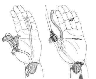 Операції на сухожиллях пальців рук, кисті: види, хід, реабілітація