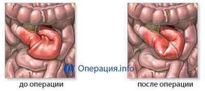 Операції при непрохідності кишечника: проведення, наслідки