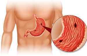Оперізуючий біль в області шлунка і спини: причини, симптоми, лікування