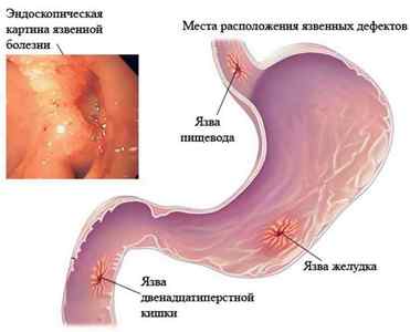 Опіхостроз Курилка: поразку паразитичними червяками печінки і підшлункової залози