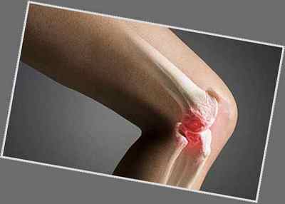 Опис операції з ендопротезування колінного суглоба