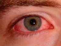 Опік очі: лікування, перша допомога при термічному опіку слизової і століття, краплі
