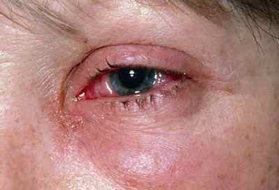 Опік очей кварцовою лампою (ультрафіолетової): лікування рогівки при опіку кварцом