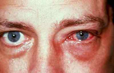 Опік рогівки ока: лікування, симптоми, наслідки, які краплі використовувати