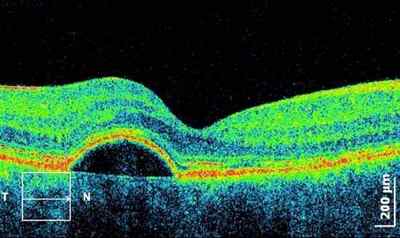 Оптична когерентна томографія сітківки ока (ОКТ): що це таке, особливості дослідження