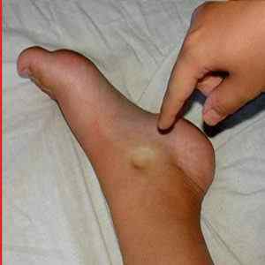 Опухла нога і покарснела: що робити і чому розпухають ноги, причини почервоніння на гомілки у літньої людини, як зняти набряк | Ревматолог