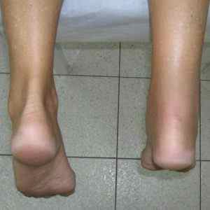 Опухла нога і покарснела: що робити і чому розпухають ноги, причини почервоніння на гомілки у літньої людини, як зняти набряк | Ревматолог