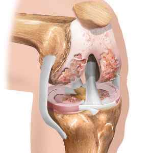 Опухло коліно і болить при згинанні: причини і лікування, як і чим зняти набряк коліна в домашніх умовах, що це може бути | Ревматолог
