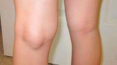 Опухло коліно і болить при згинанні: причини і лікування, як і чим зняти набряк коліна в домашніх умовах, що це може бути | Ревматолог