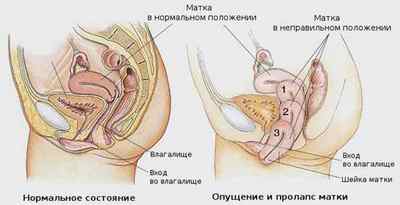 Опущення матки: ступеня, причини, симптоми і лікування