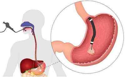 Опущення шлунка: симптоми і ознаки, якими методами діагностувати