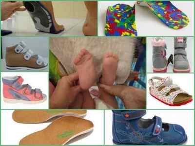 Ортопедичне взуття для дітей при вальгусной деформації стопи - як вибрати, відгуки